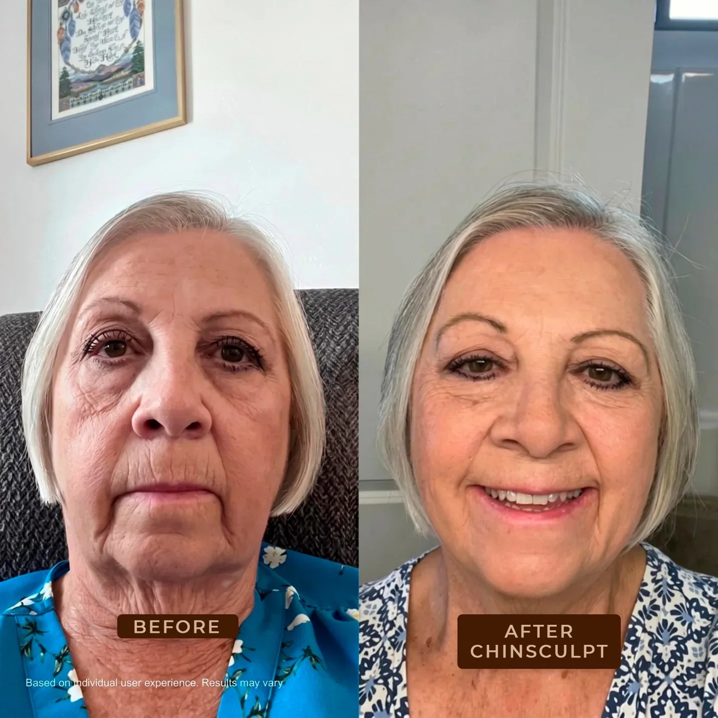 ChinSculpt - Jawline Contouring Mask